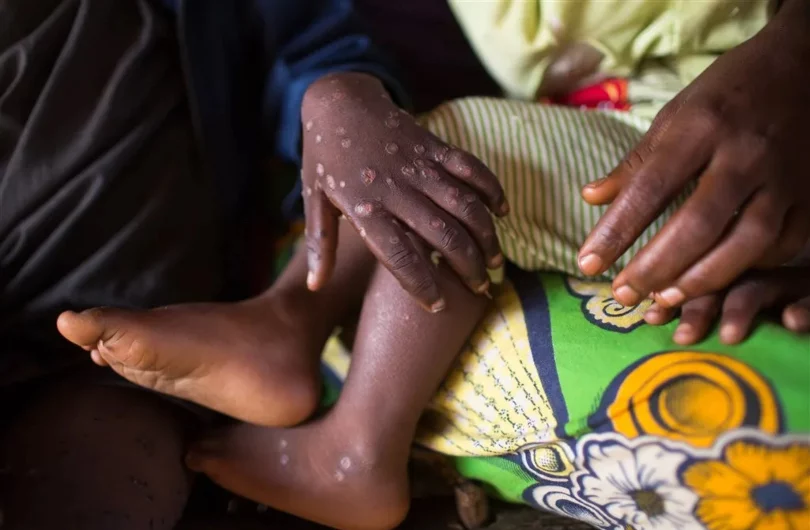 Penyakit Monkeypox Di Malaysia : Berhati-hati Dengan Gejala 24 monkeypox img imbd 02 jpg